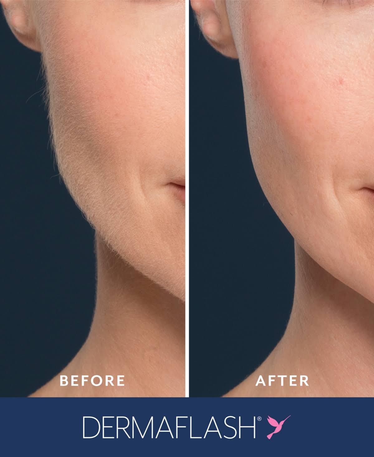 Dermaflash One Exfoliation Peach Fuzz Removal Device - Silver-Tone