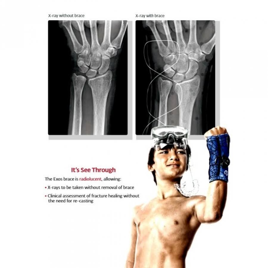 Exos Boxer Fracture Brace, Right Hand, Large